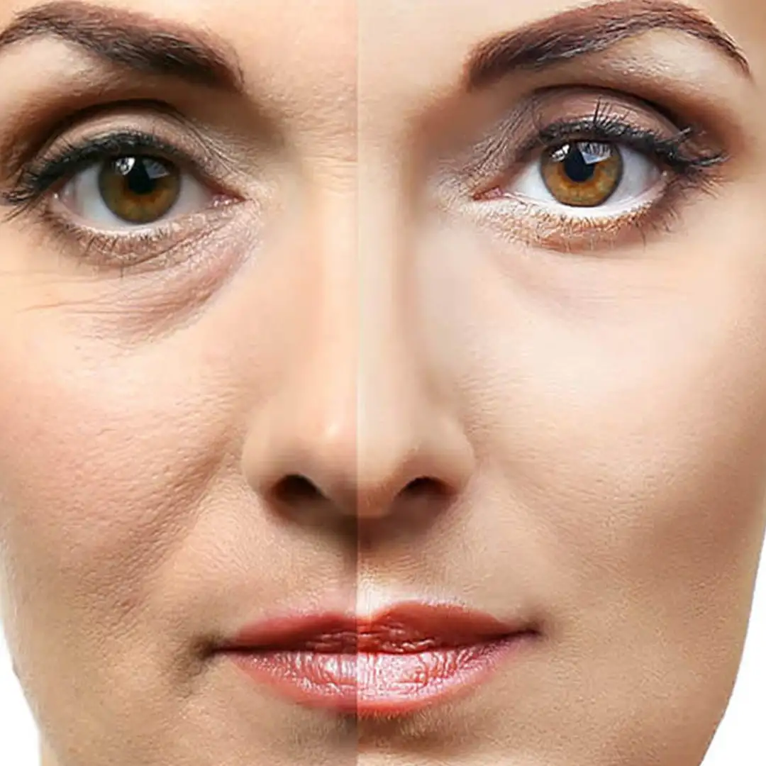 Collagen Filler, Apakah Bermanfaat Mengatasi Keriput?