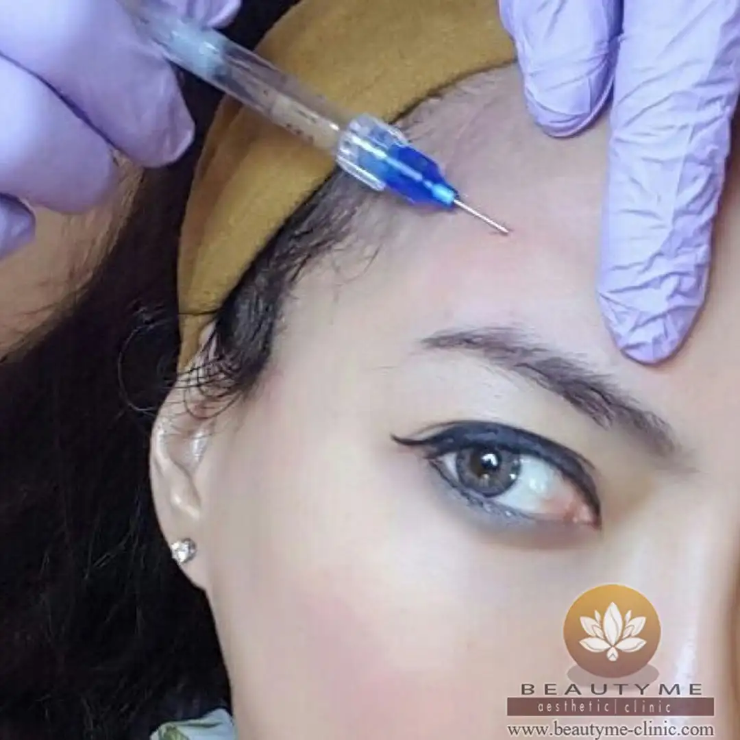 Temporal Atau Forehead Augmentation