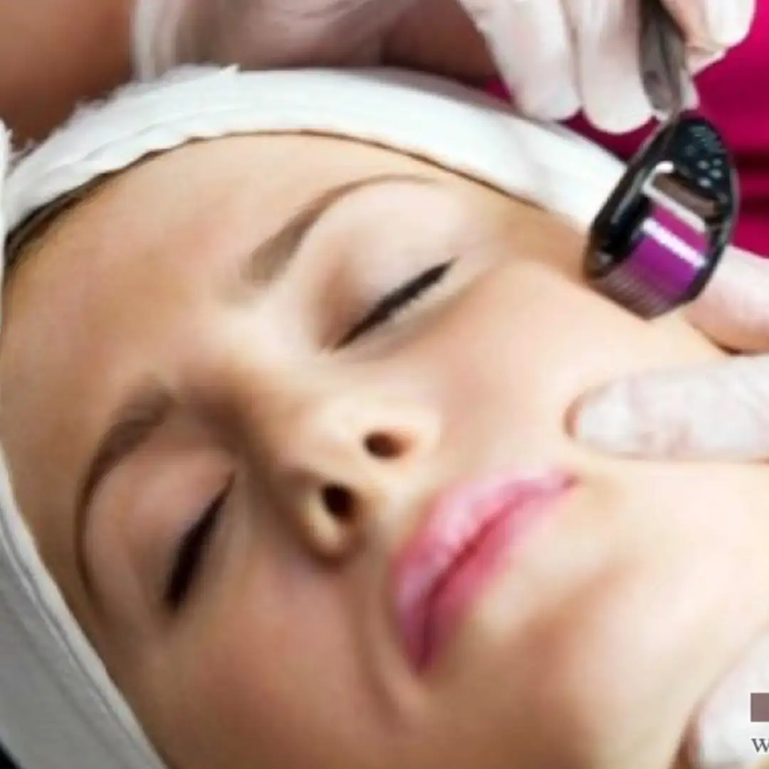 Terapi Dermaroller Ideal