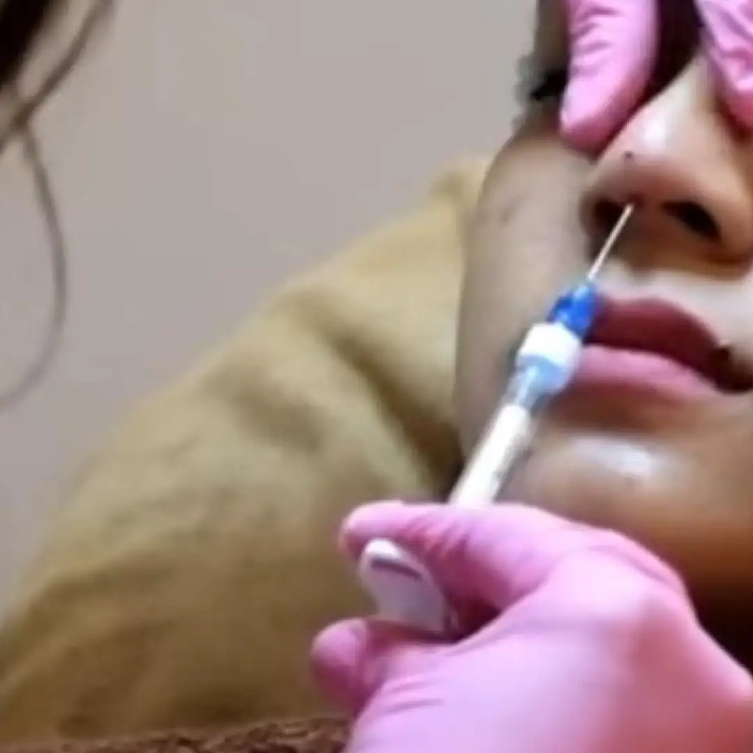 Treatment Untuk Meniruskan Wajah dan Pipi