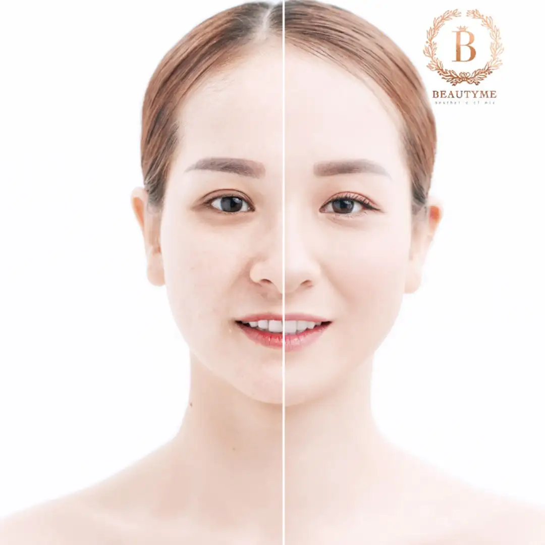 Light Skin Treatment