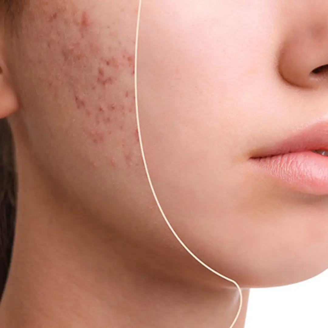 Terapi Jerawat Atau Acne Treatment