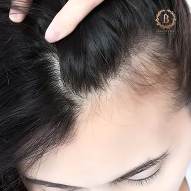 Mengapa Kamu Butuh Kombinasi Hair Growth Treatment dan Booster?