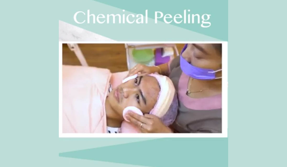 acne peeling