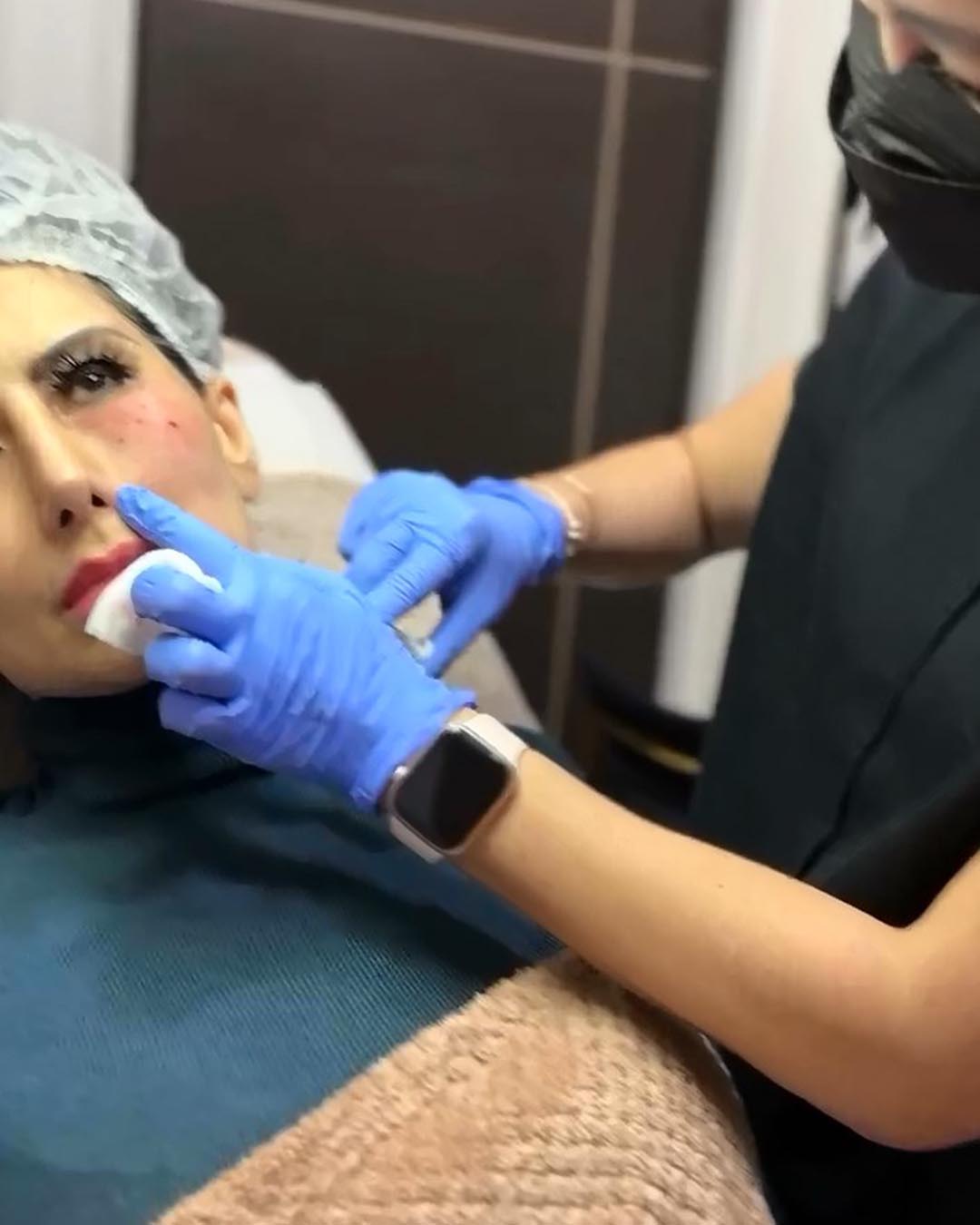 Ellanse Collagen Stimulator Filler